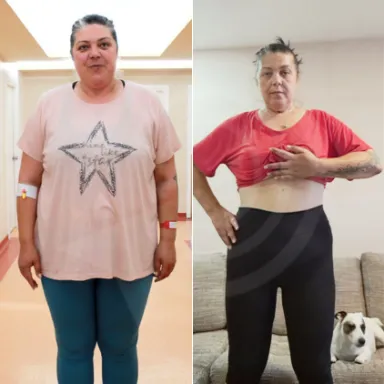 Gastric Sleeve