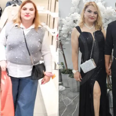 Gastric Sleeve
