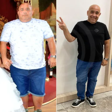 Gastric Sleeve