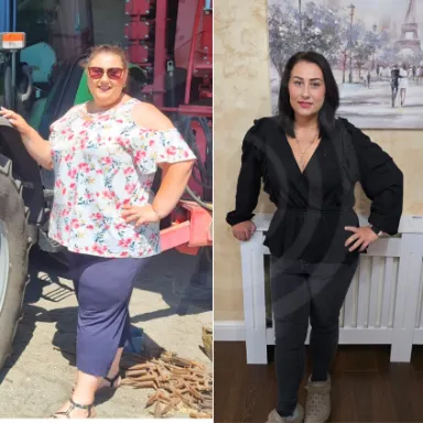 Gastric Sleeve