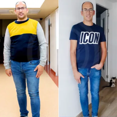 Gastric Sleeve