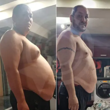 Gastric Sleeve