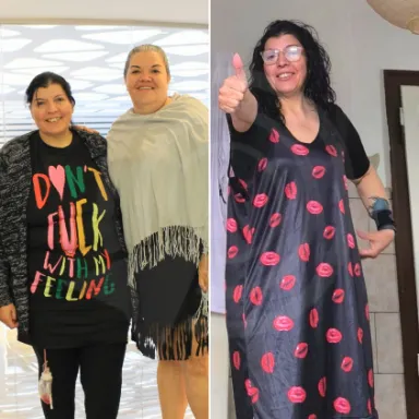 Gastric Sleeve
