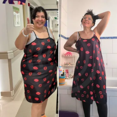 Gastric Sleeve