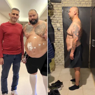 Gastric Sleeve