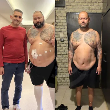 Gastric Sleeve