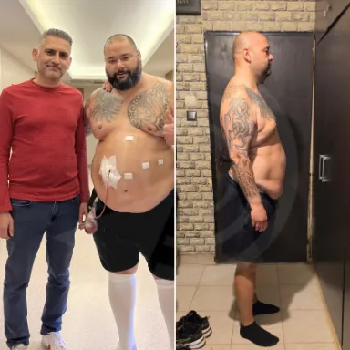 Gastric Sleeve