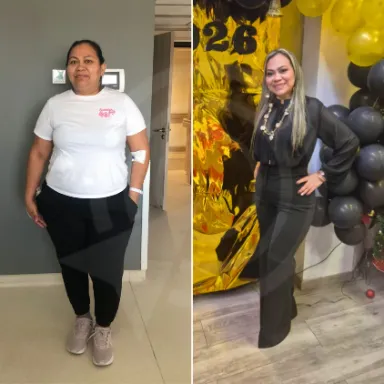 Gastric Sleeve