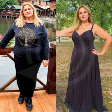 Gastric Sleeve