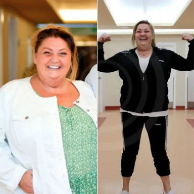 Gastric Sleeve