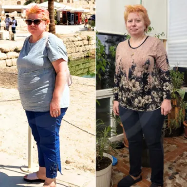Gastric Sleeve