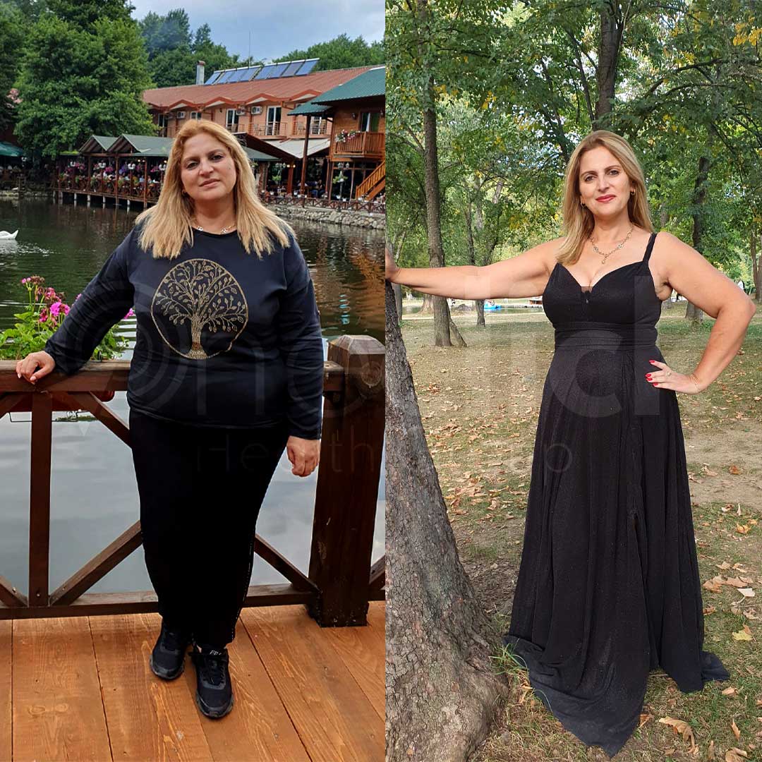Gastric Sleeve