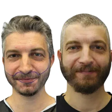 Hair Transplant