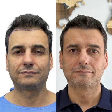 Hair Transplant