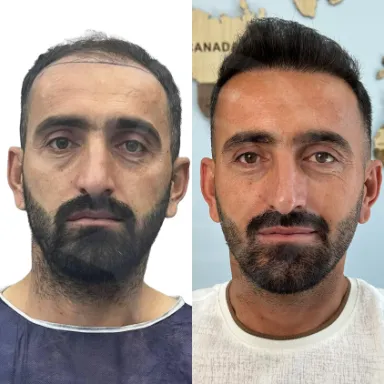 Hair Transplant