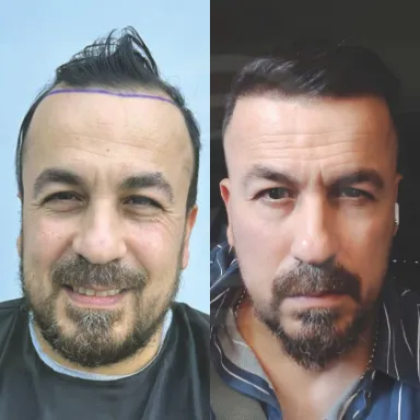 Hair Transplant