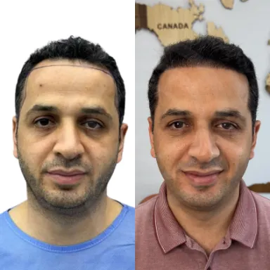 Hair Transplant
