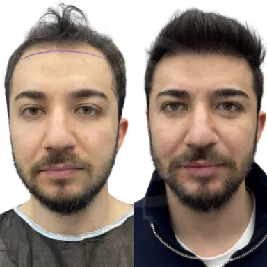 Hair Transplant