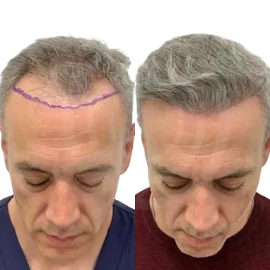 Hair Transplant