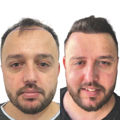 Hair Transplant