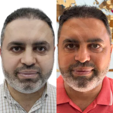 Hair Transplant