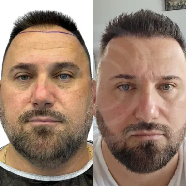 Hair Transplant