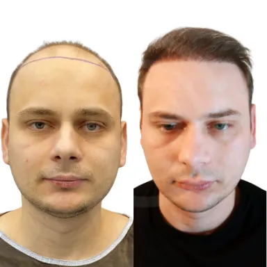 Hair Transplant
