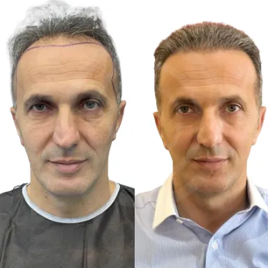 Hair Transplant