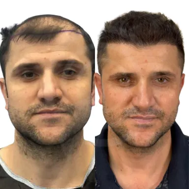 Hair Transplant