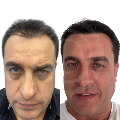 Hair Transplant