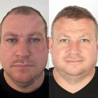 Hair Transplant
