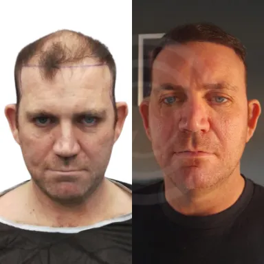 Hair Transplant