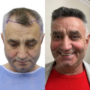 Hair Transplant