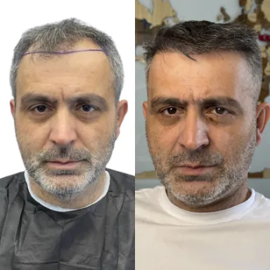 Hair Transplant
