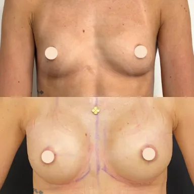 Breast Augmentation