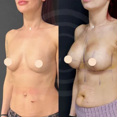 Breast Augmentation