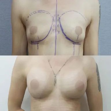 Breast Augmentation