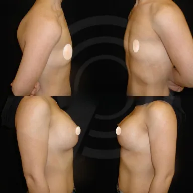 Breast Augmentation