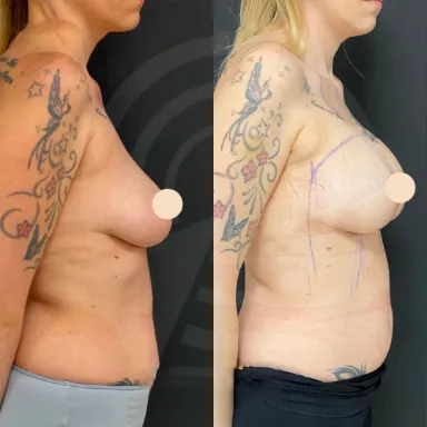 Breast Augmentation
