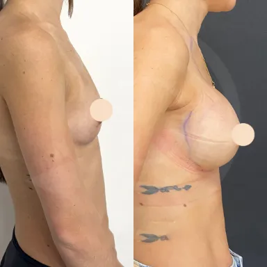 Breast Augmentation