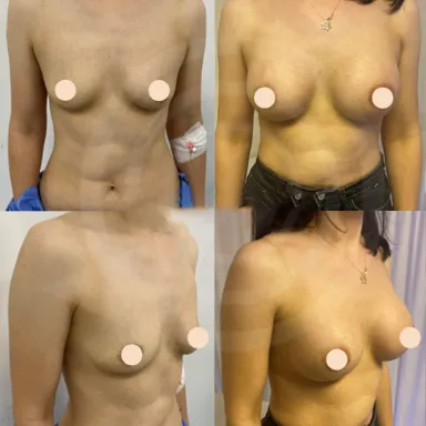 Breast Augmentation