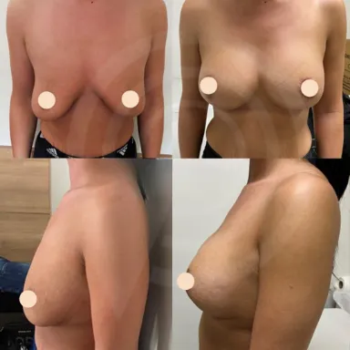Breast Augmentation