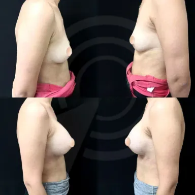 Breast Augmentation