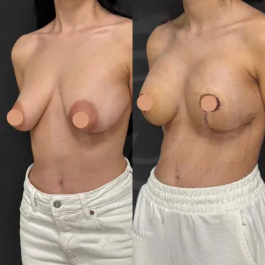 Breast Uplift