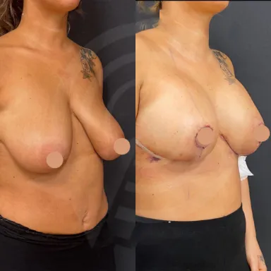 Breast Uplift