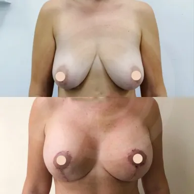Breast Uplift