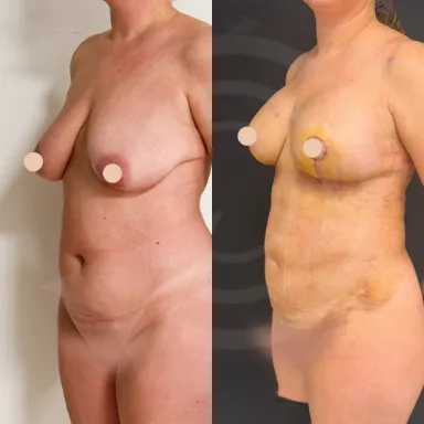 Breast Uplift