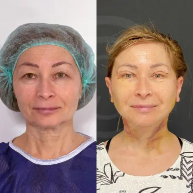 Facelift