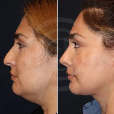 Facelift