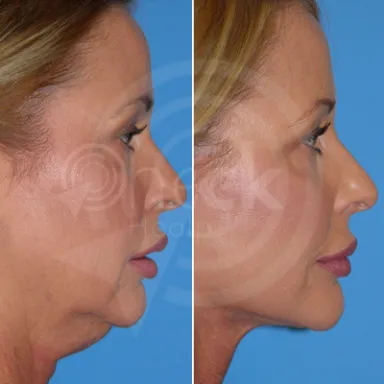 Facelift